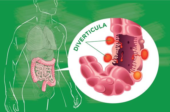 On the Rise: Understanding Diverticulitis and Why It’s Affecting More of Us