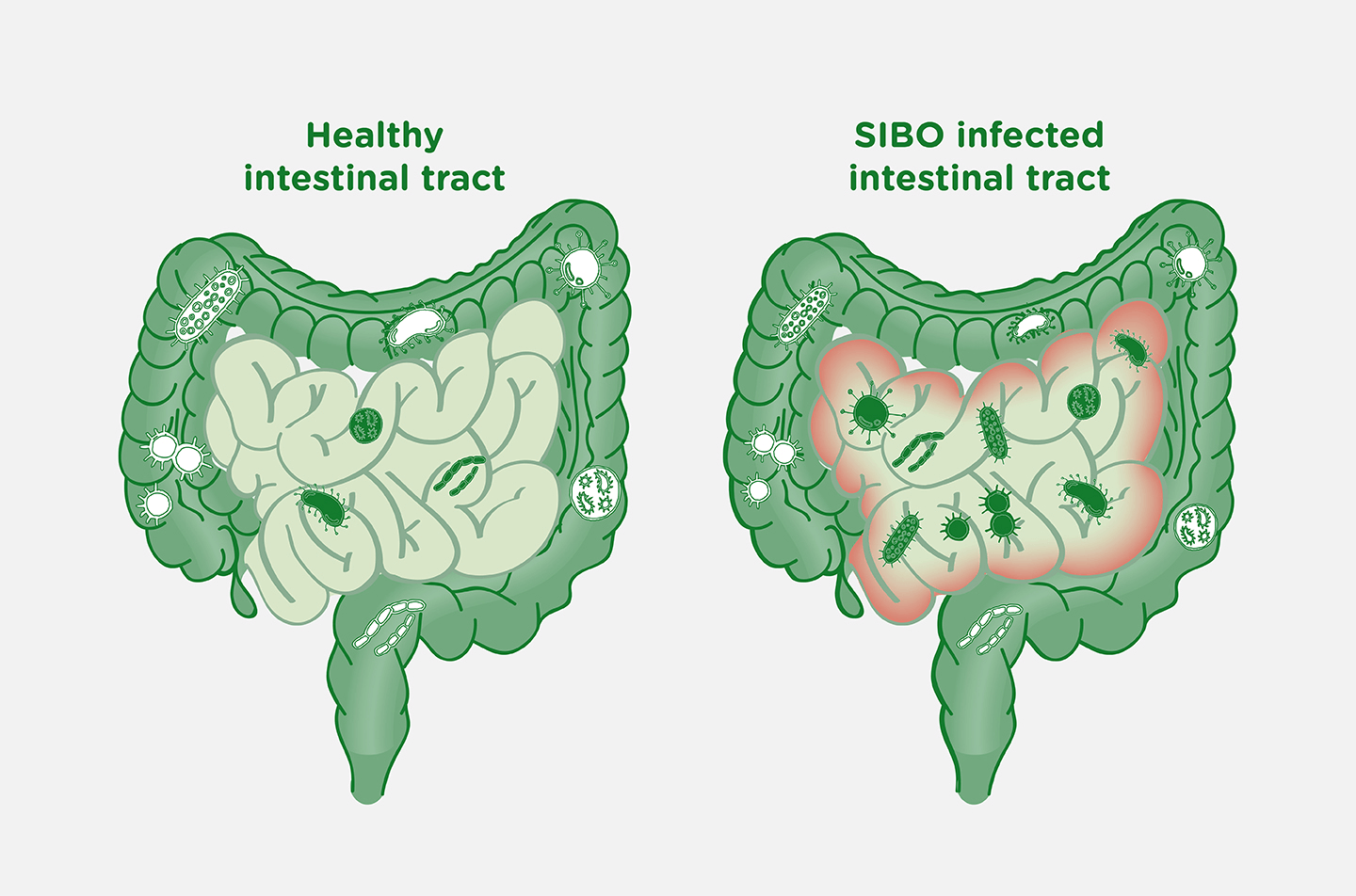 SIBO: How Small Intestinal Bacterial Overgrowth Impacts the Microbiome –  Bio-K+