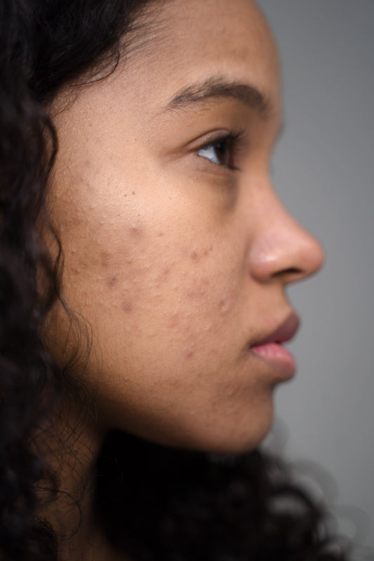 Young woman with acne-prone skin in profile, illustrating the gut-skin connection