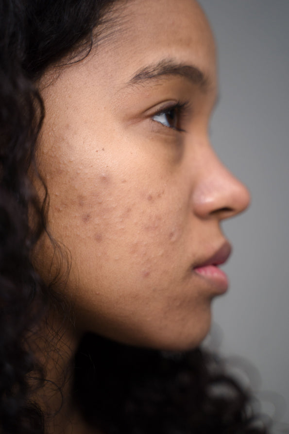 Young woman with acne-prone skin in profile, illustrating the gut-skin connection
